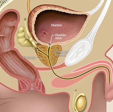 Urinary Tract Obstruction